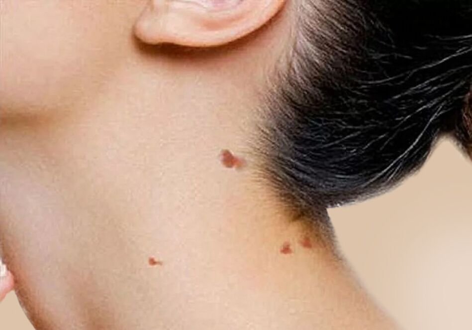 Появата на папиломи на шията след активиране на HPV в тялото
