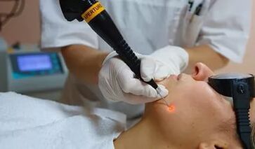 Ефективна процедура за премахване на папилома по лицето с лазер