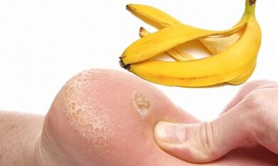 Banana Peel за лечение на плантарна брадавица