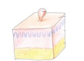 как да се отървете от папилома по тялото