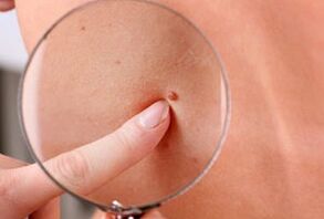 причини за появата на папиломи върху човешкото тяло